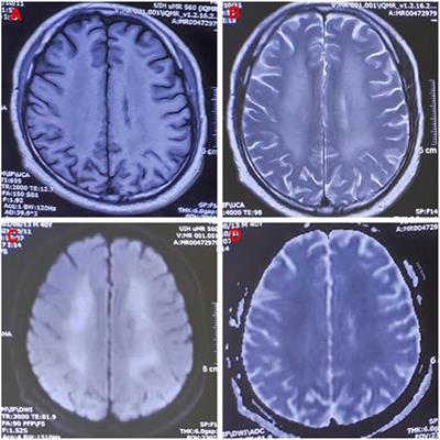 Methemoglobinemia and Delayed Encephalopathy After 5-Bromo-2-Nitropyridine Poisoning: A Rare Case Report